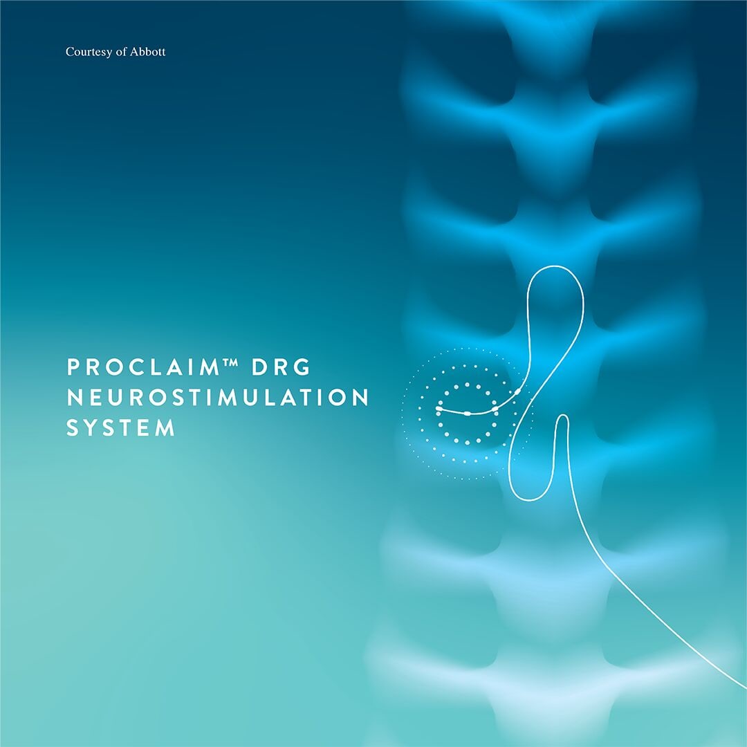 Illustration of an Abbott DRG lead curving around a dorsal root ganglion alongside the vertebral column