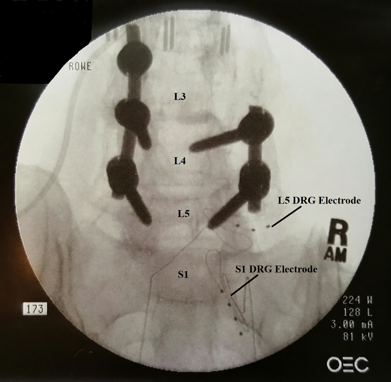 AP fluoroscopic image showing labeled right L5 and S1 DRG electrodes beside lumbar fusion hardware