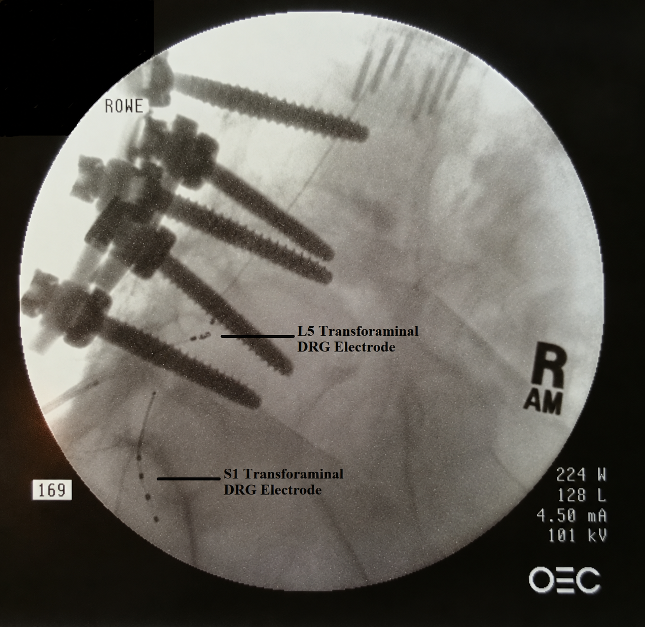 Lateral fluoroscopic image showing labeled L5 and S1 transforaminal DRG electrodes beside lumbar fusion hardware